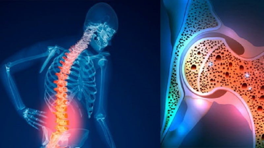پوکی استخوان از دهه چهارم زندگی شروع می‌شود