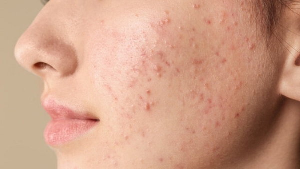 تغذیه ناسالم و تاثیرات آن بر پوست: شناسایی ۶عارضه پوستی