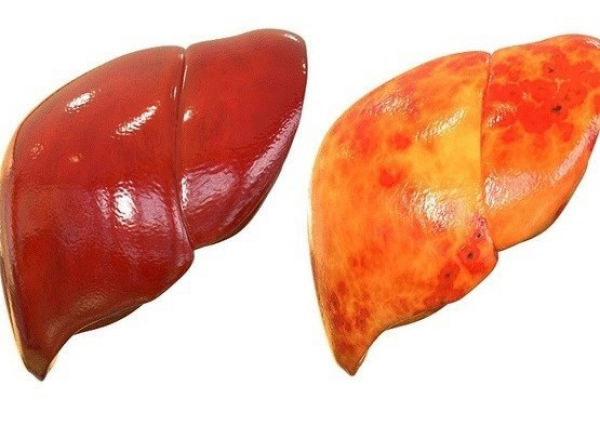 آشنایی با بهترین روشهای طب سنتی برای درمان "کبد چرب"