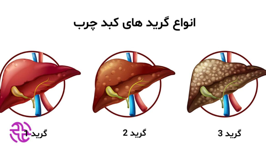 کبد چرب، چند گرید دارد؟