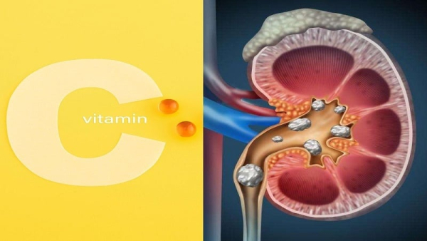 با مصرف زیاد این ویتامین، سنگ کلیه می‌گیرید